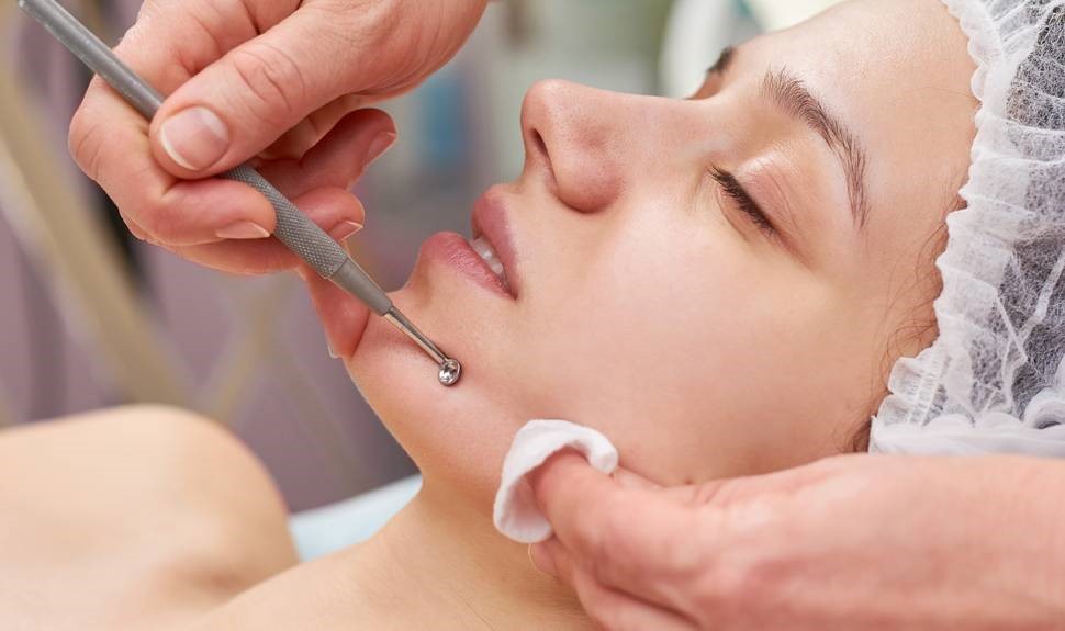 Facial Extractions