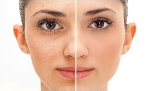 facial acupuncture