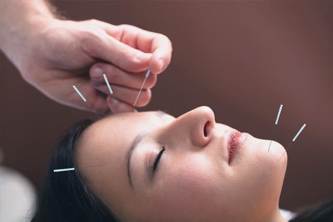 facial acupuncture